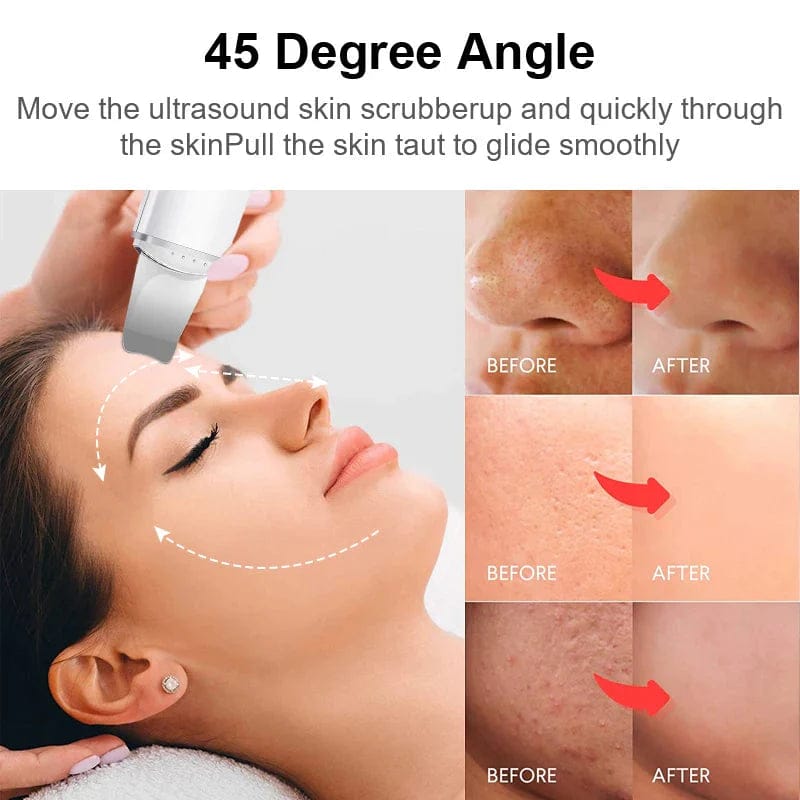 Ultrasonic Skin Scrubber for Deep Blackhead Removal - Professional Facial Cleansing Device